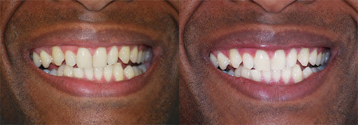 Bain de bouche Black au charbon actif
250 ml