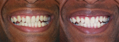 Bain de bouche Black au charbon actif
250 ml